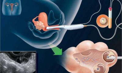 Egg Freezing Procedure Women Fertility Clinic