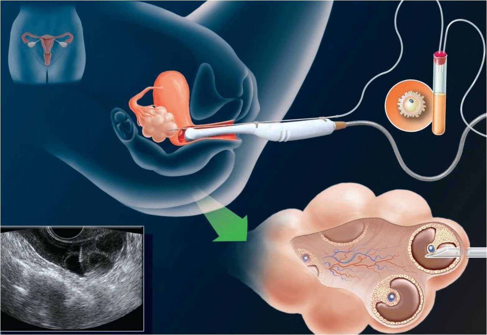 Egg Freezing Procedure Women Fertility Clinic