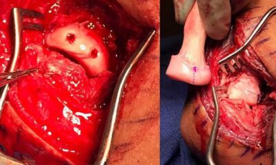 Ken Roczen Motocross Injury Surgery