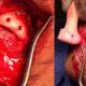 Ken Roczen Motocross Injury Surgery