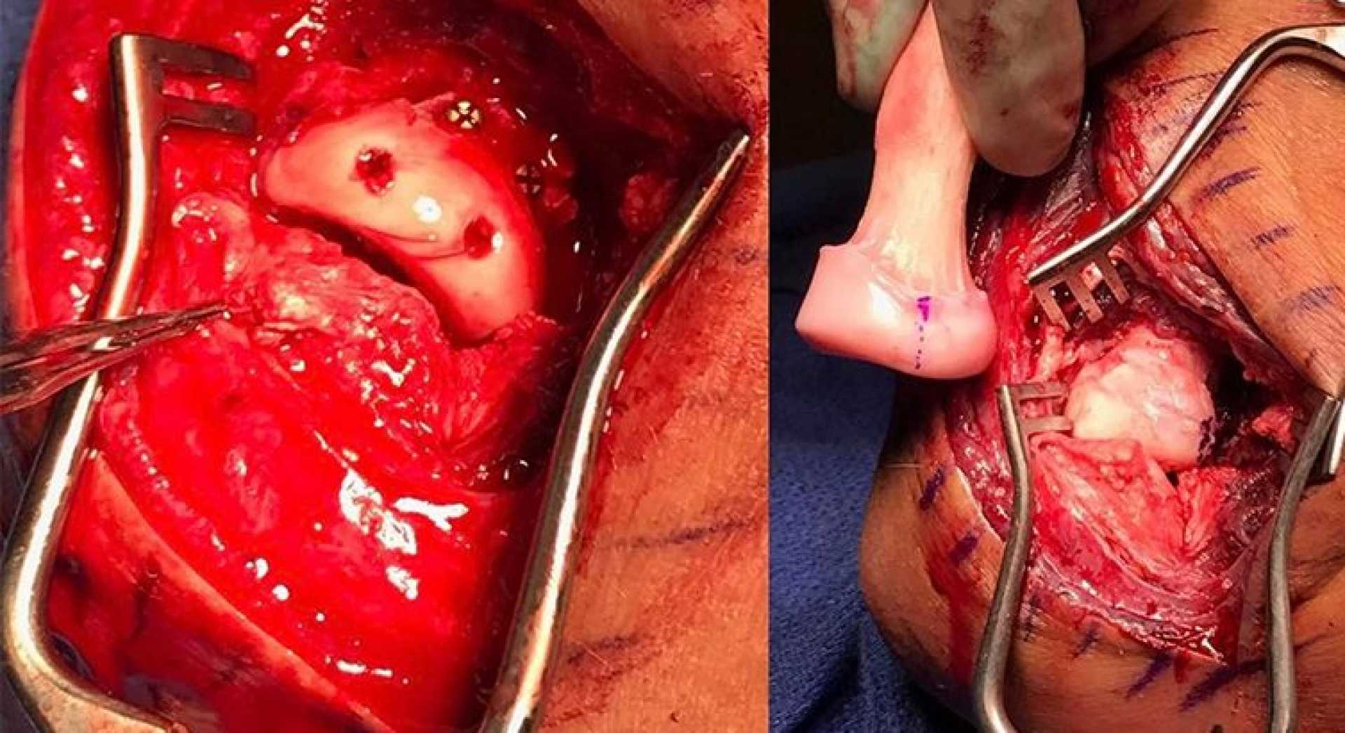 Ken Roczen Motocross Injury Surgery