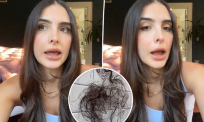 Sophia Umansky Mounjaro Hair Loss