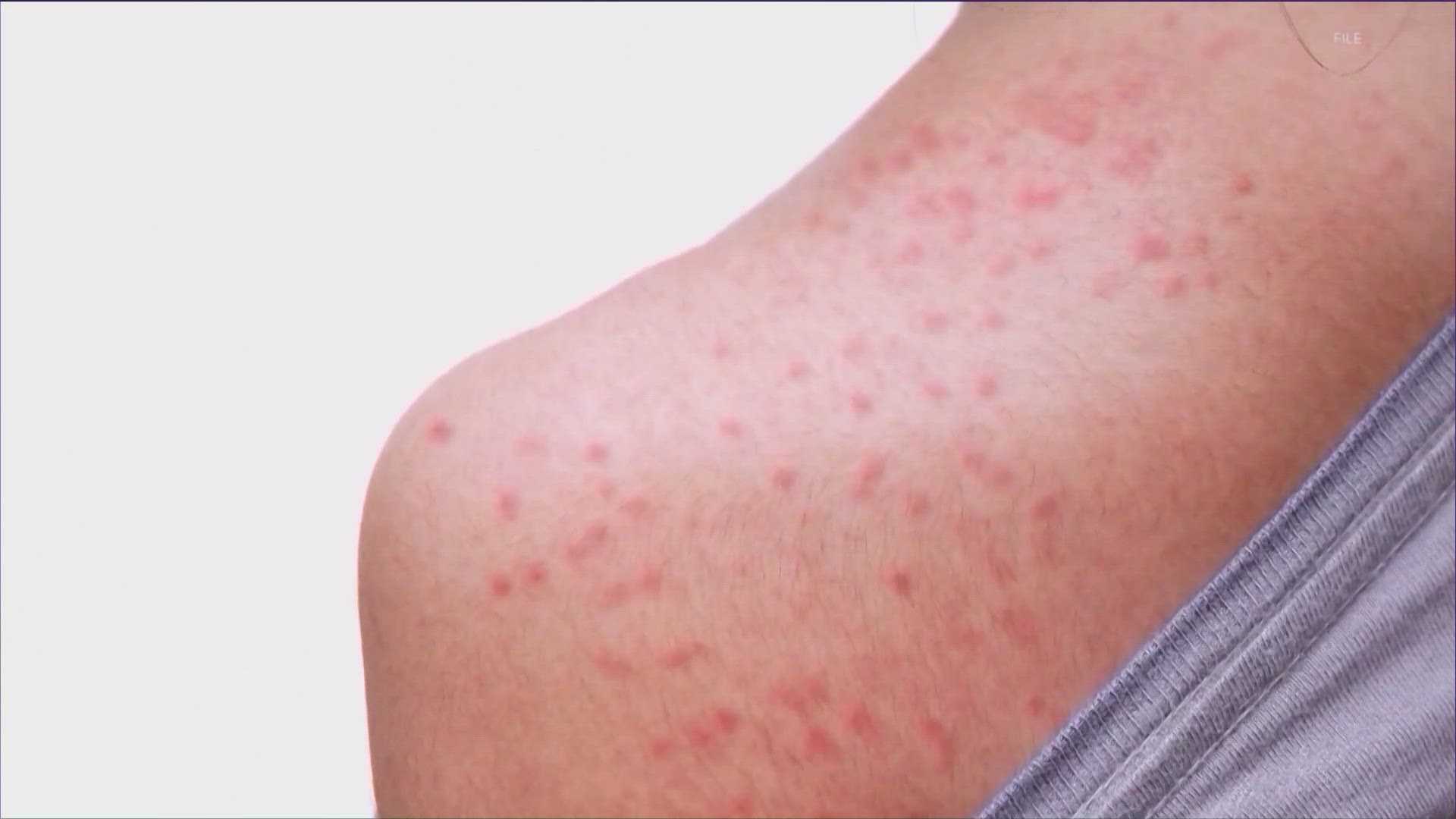 Williamson County Measles Outbreak