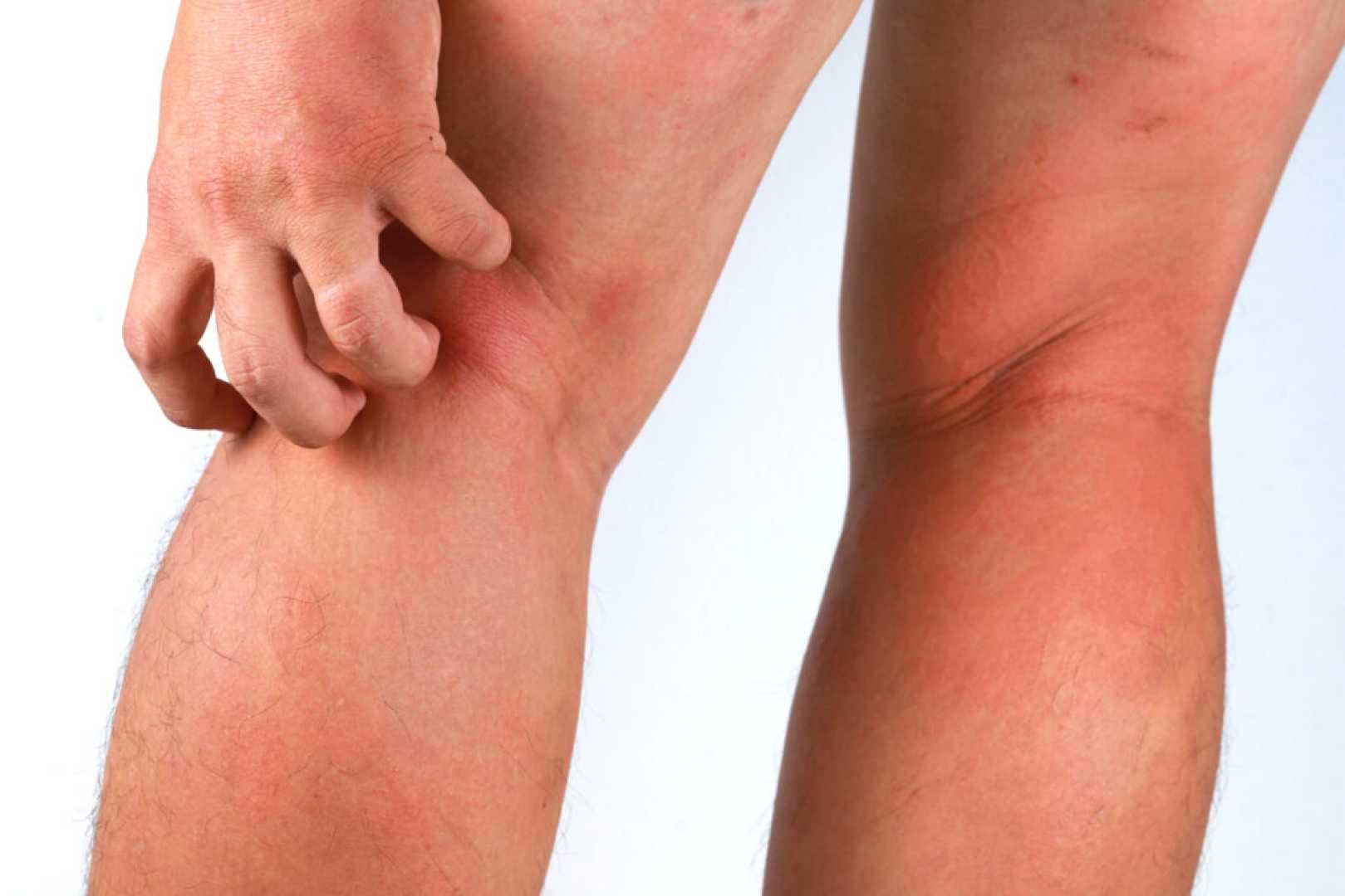 Rezpegaldesleukin Nektar Therapeutics Atopic Dermatitis