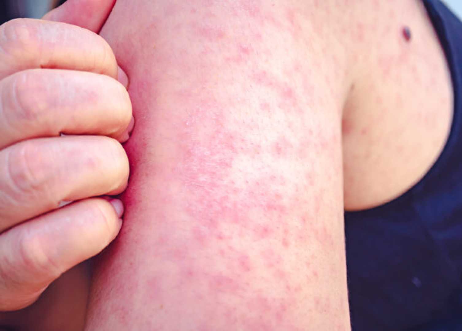 Florida Measles Outbreak News