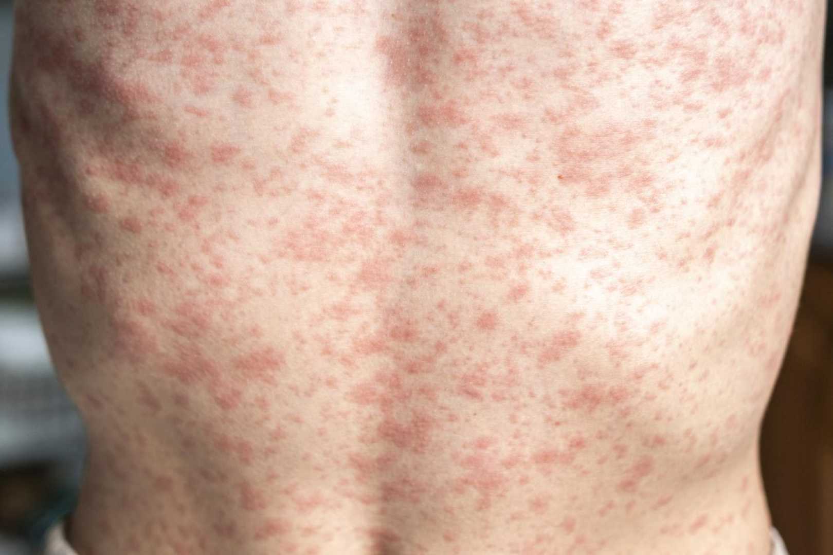 Measles Outbreak In Texas And New Mexico