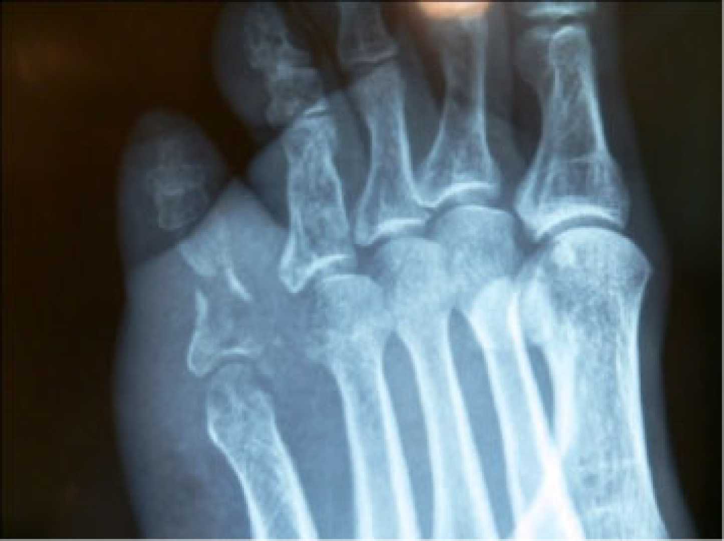 Metastatic Cancer Finger Toe X Ray