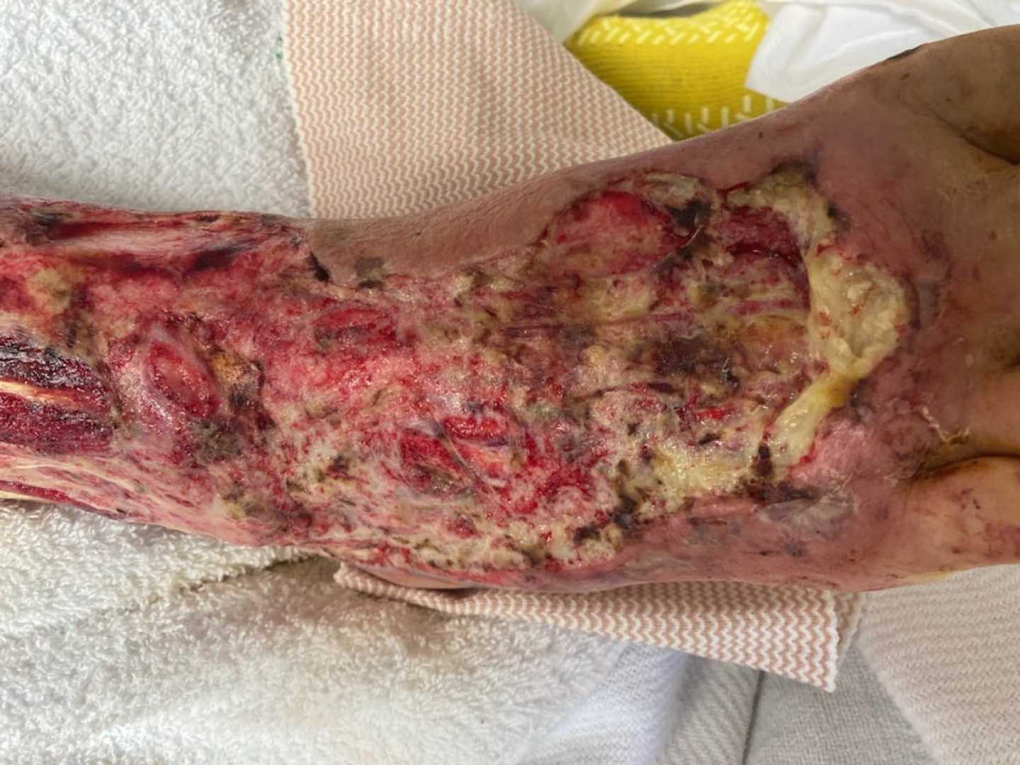 Vibrio Vulnificus Infection In Florida