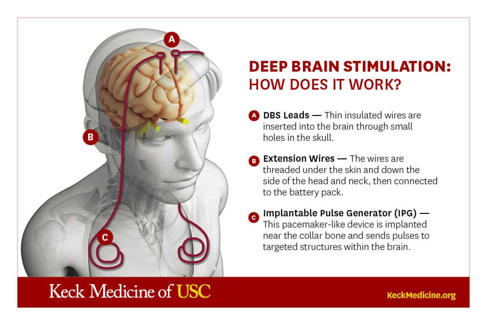 Deep Brain Stimulation Parkinson's Disease