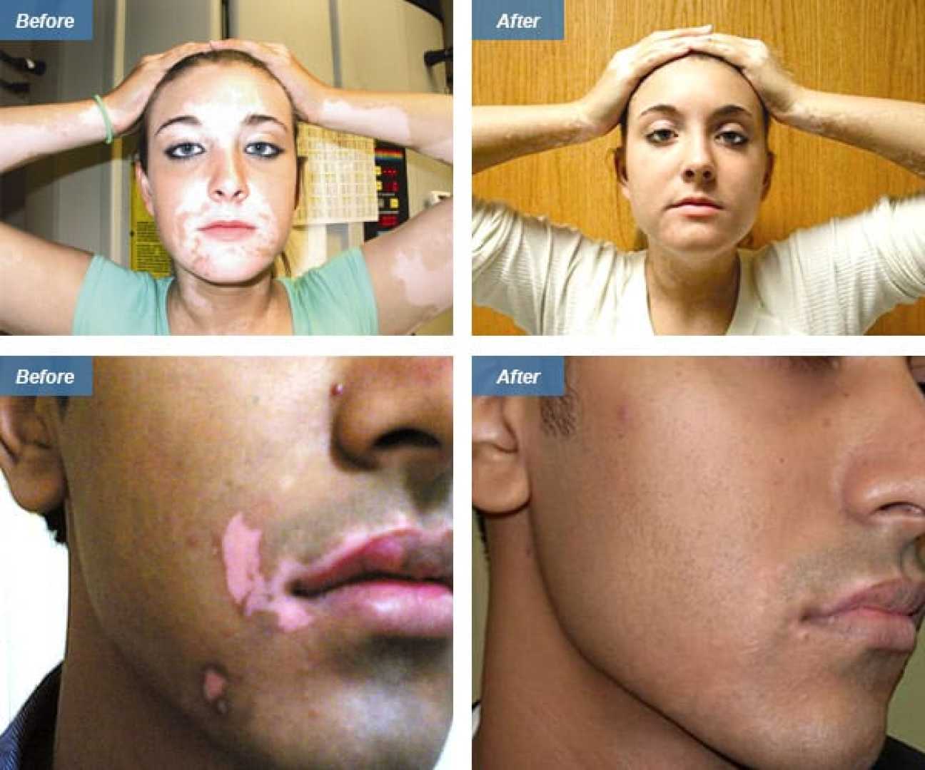 Excimer Laser Treatment For Vitiligo