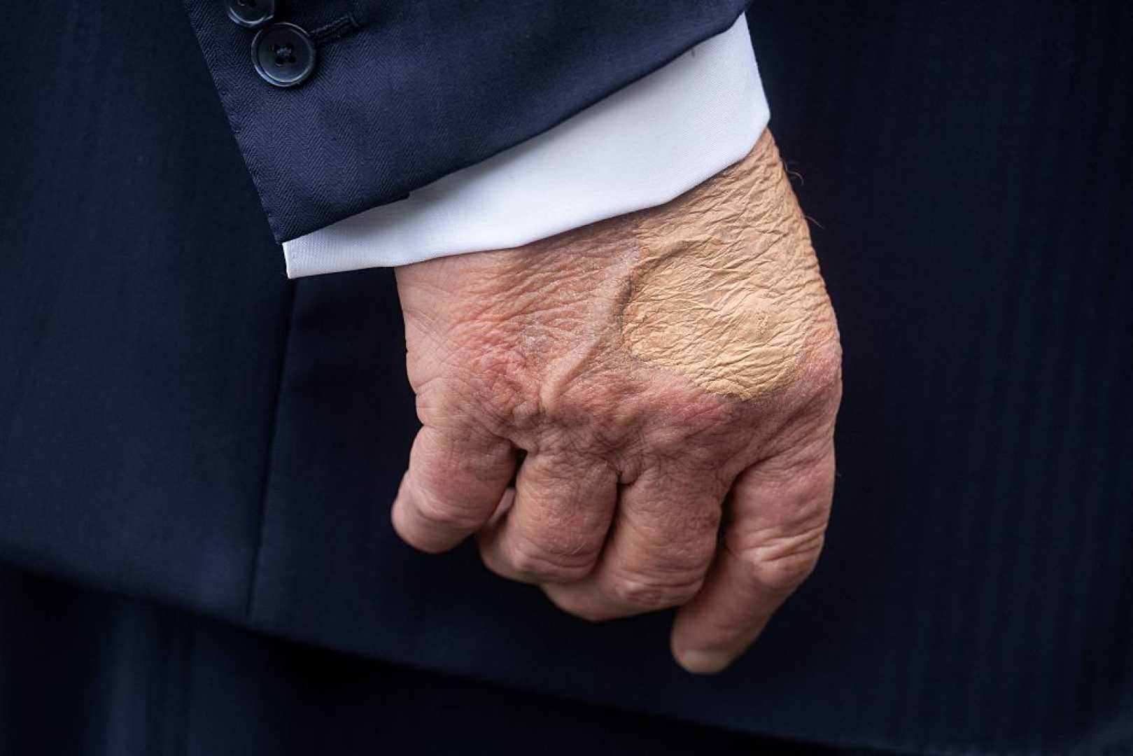 Trump Makeup Hand Health Issues