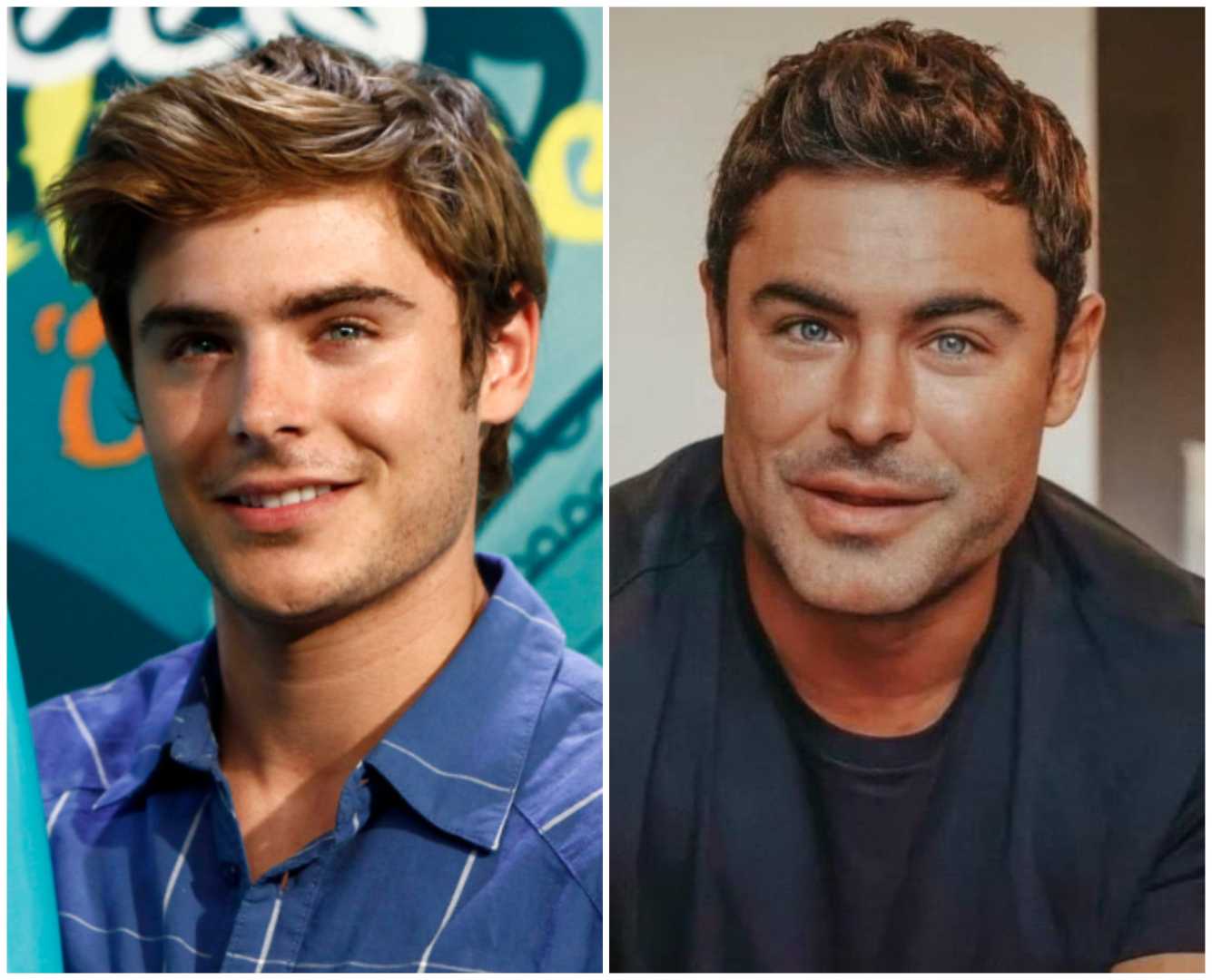 Zac Efron Jawline Plastic Surgery News