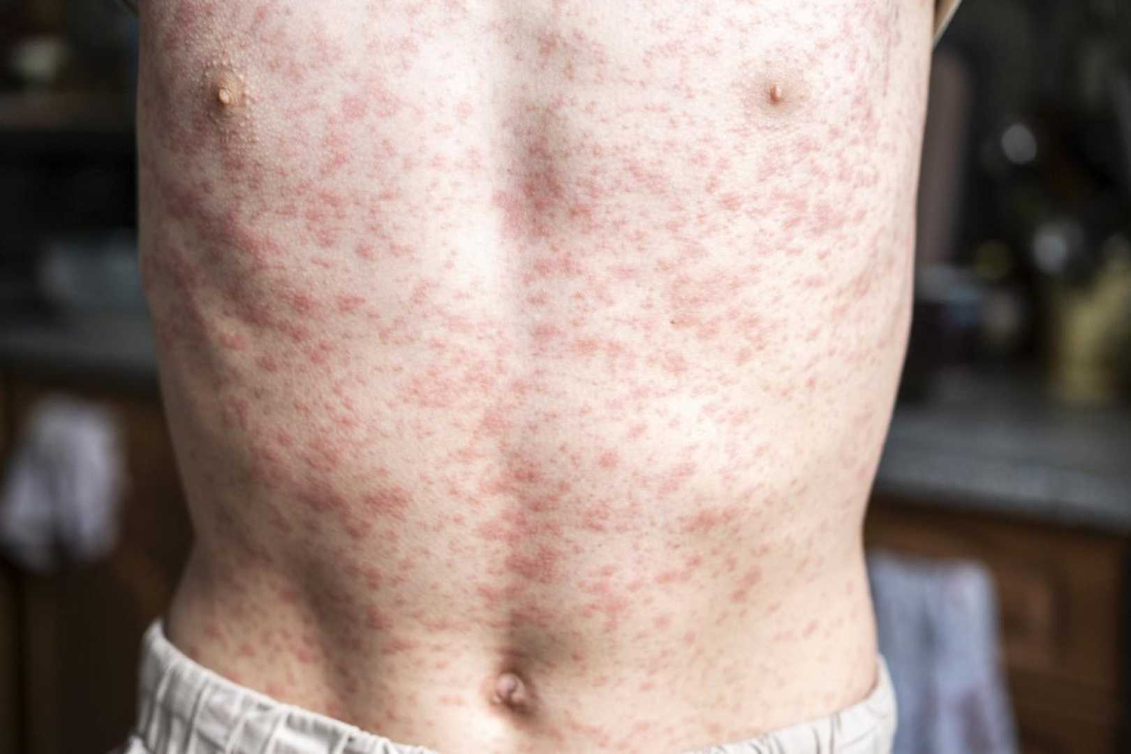 Measles Outbreak South Carolina Canada