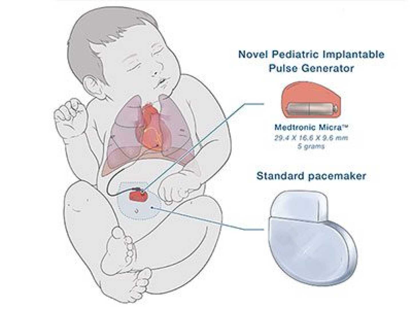 Wireless Pacemaker For Infants