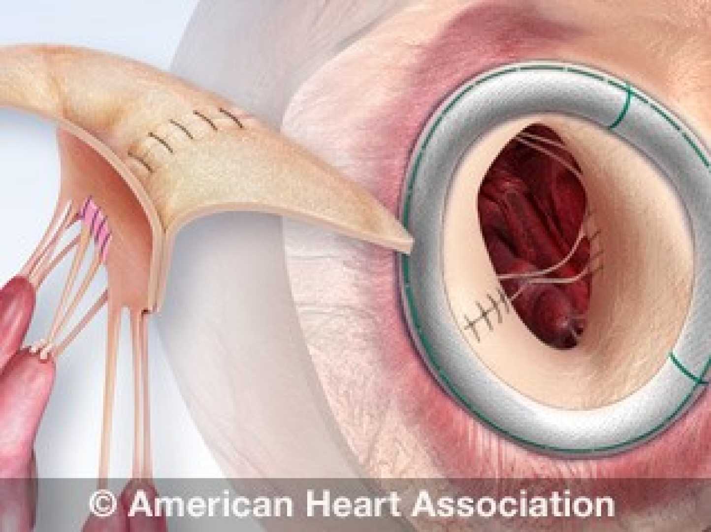 American Heart Association Aortic Stenosis Treatment